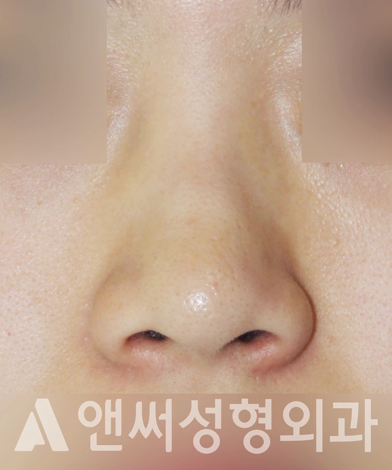 Answer Plastic Surgery case 447: Before