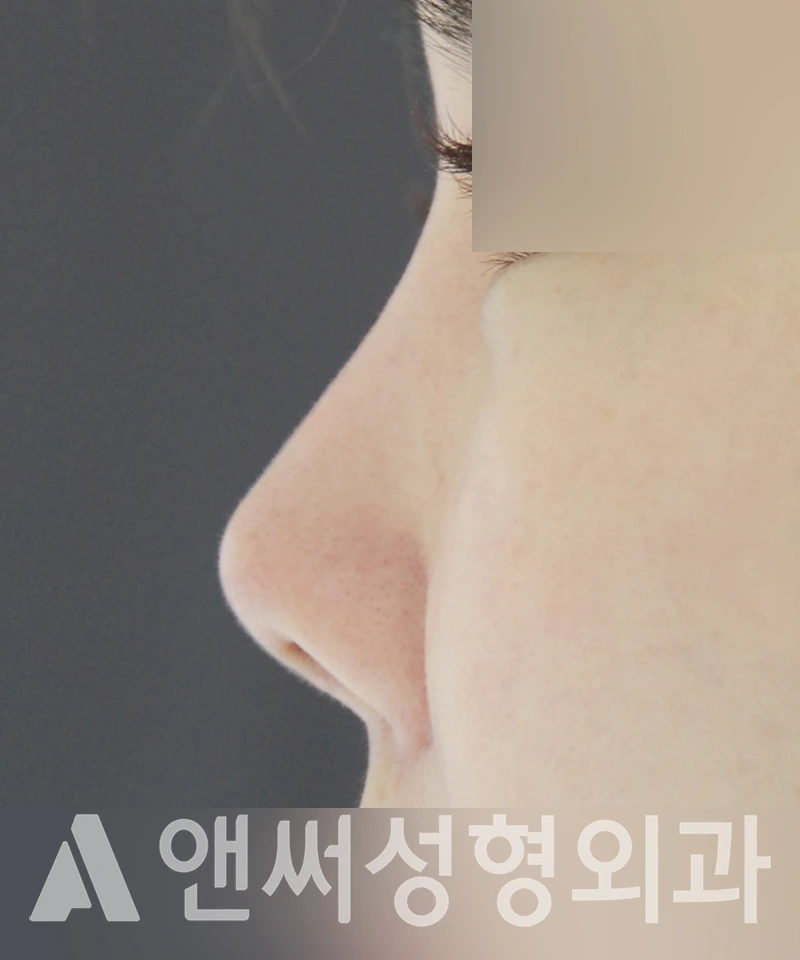 Answer Plastic Surgery case 446: Before
