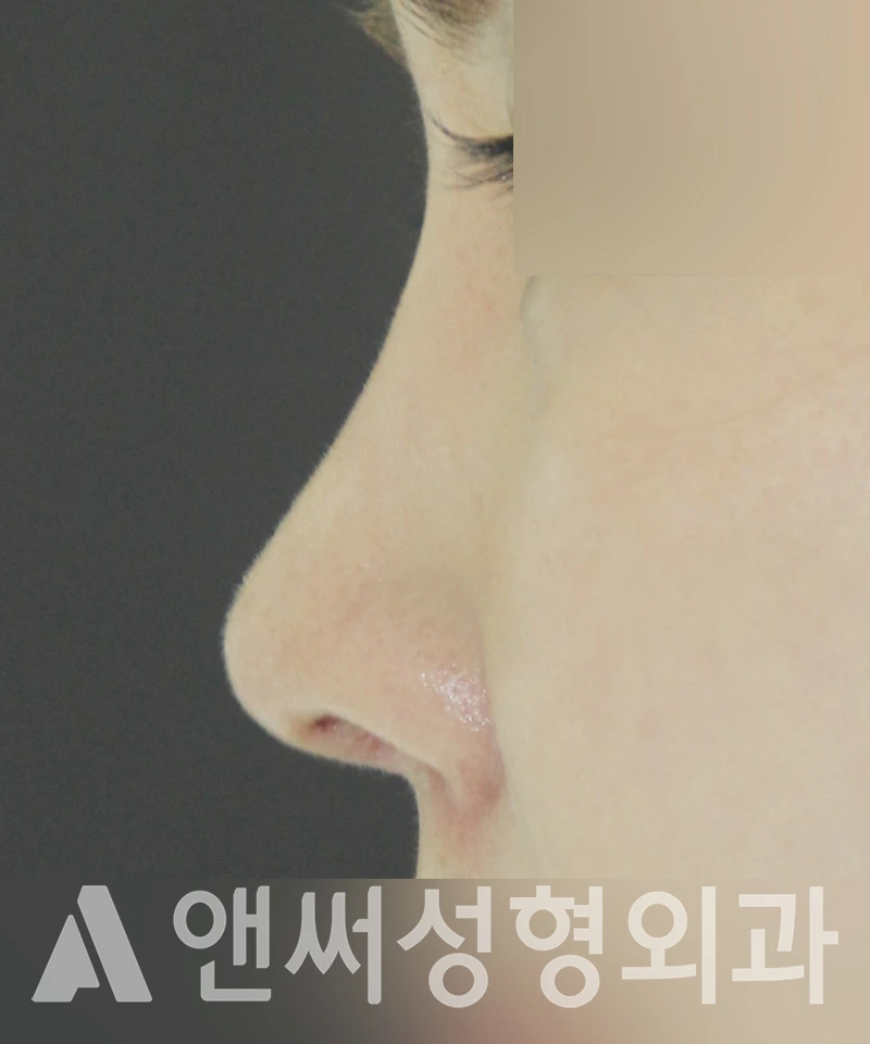 Answer Plastic Surgery case 446: After
