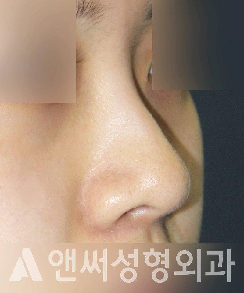 Answer Plastic Surgery case 445: Before