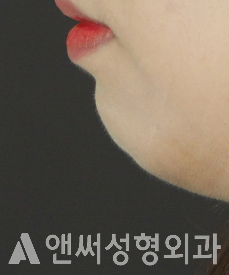 Answer Plastic Surgery case 444: Before