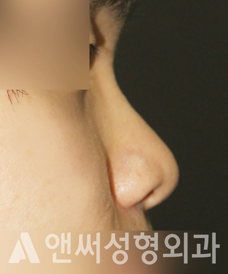 Answer Plastic Surgery case 443: Before