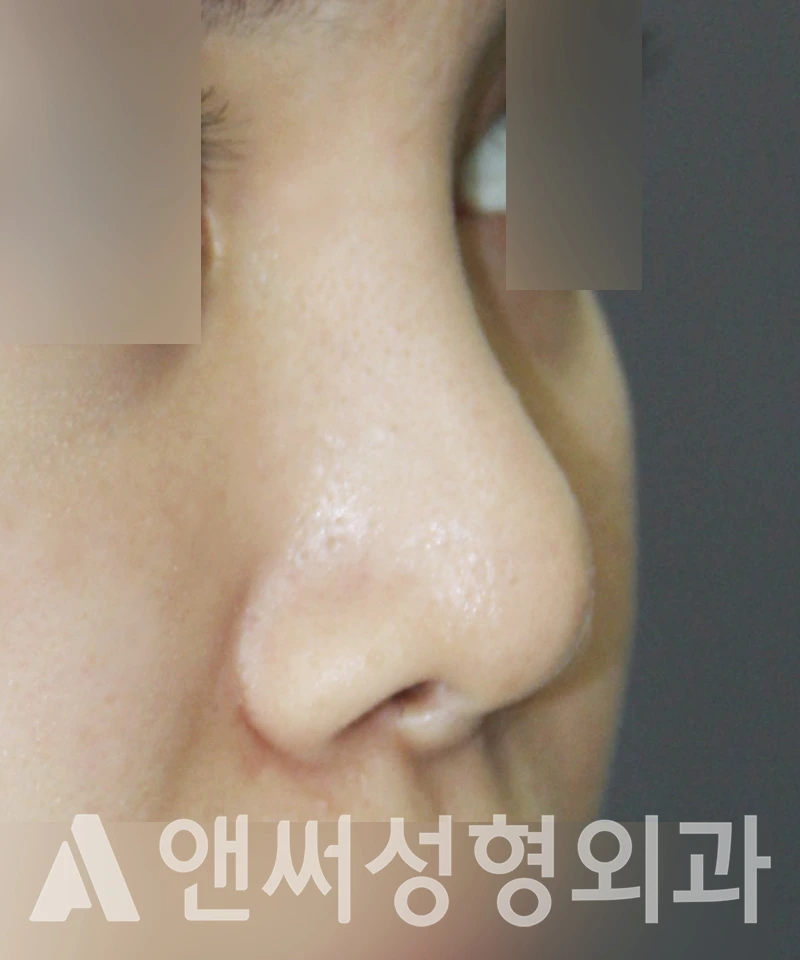 Answer Plastic Surgery case 442: Before