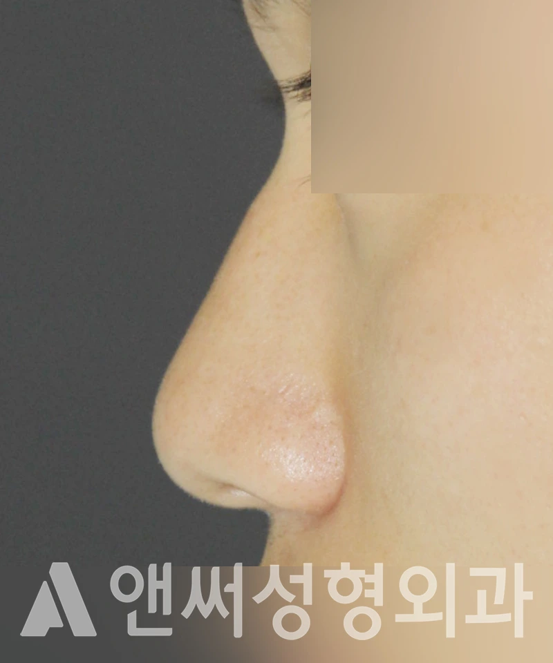 Answer Plastic Surgery case 441: Before