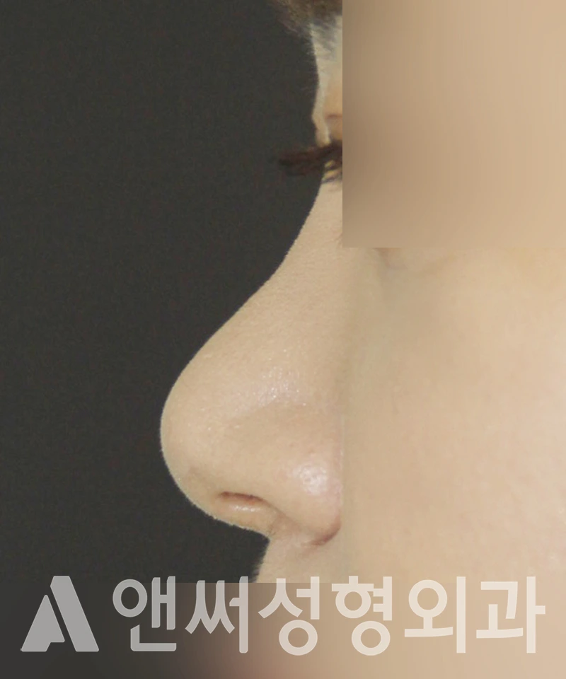 Answer Plastic Surgery case 440: Before