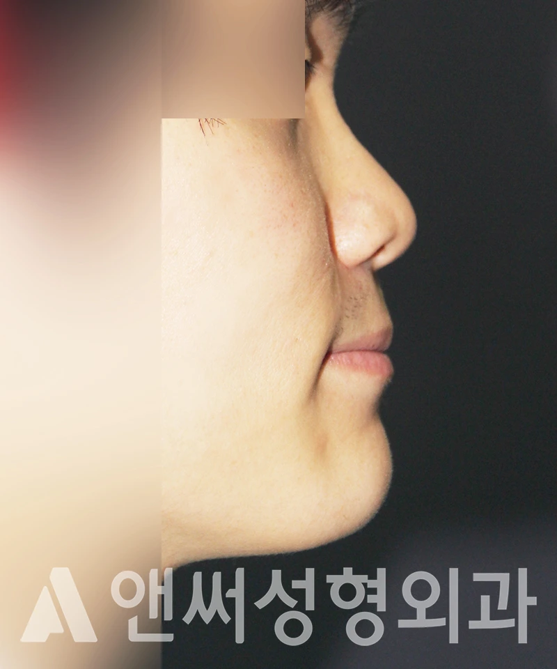 Answer Plastic Surgery case 438: Before