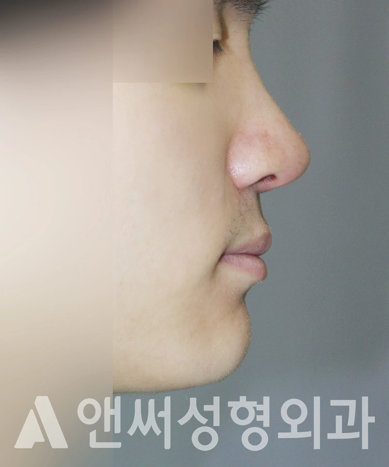 Answer Plastic Surgery case 438: After