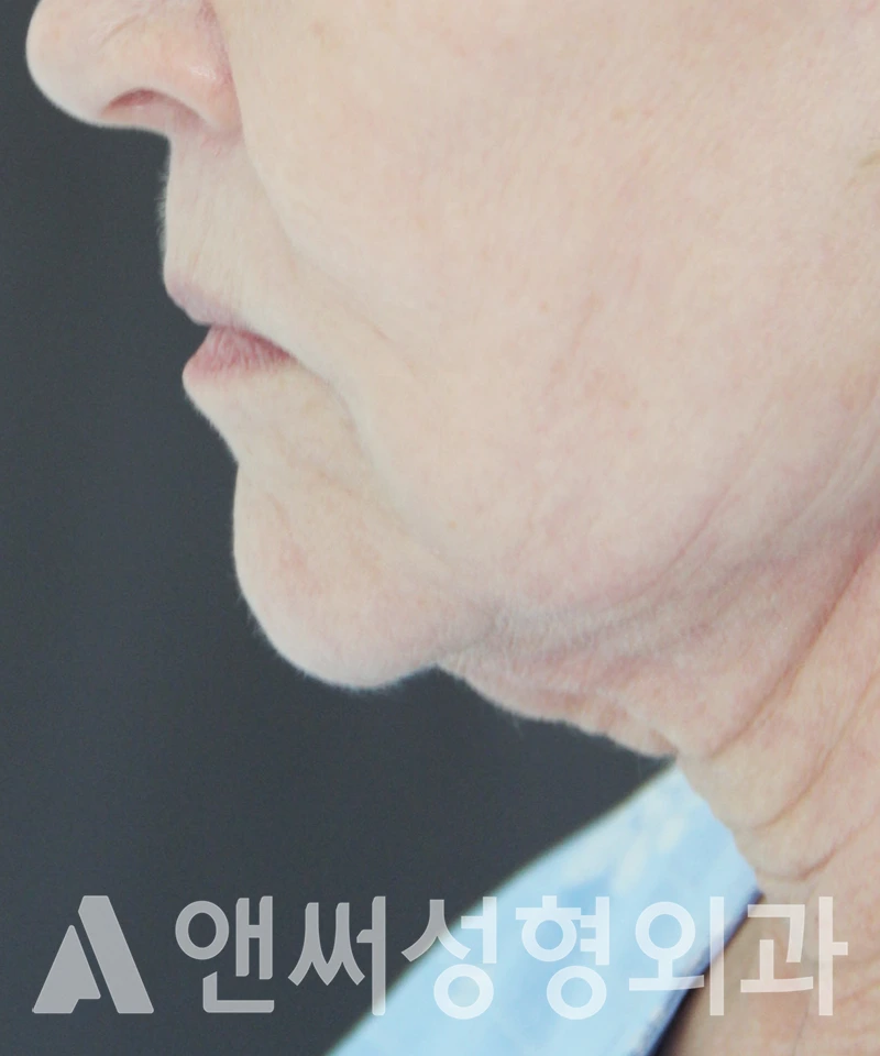 Answer Plastic Surgery case 437: Before