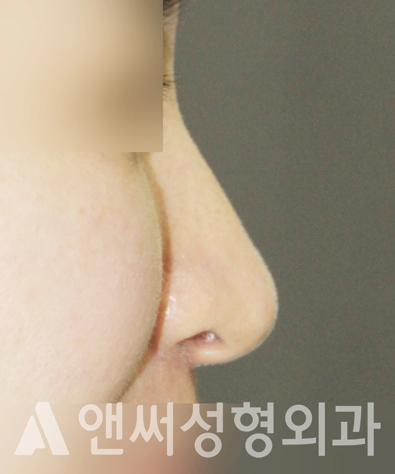 Answer Plastic Surgery case 436: Before