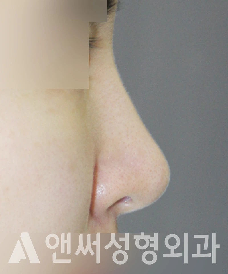 Answer Plastic Surgery case 436: After
