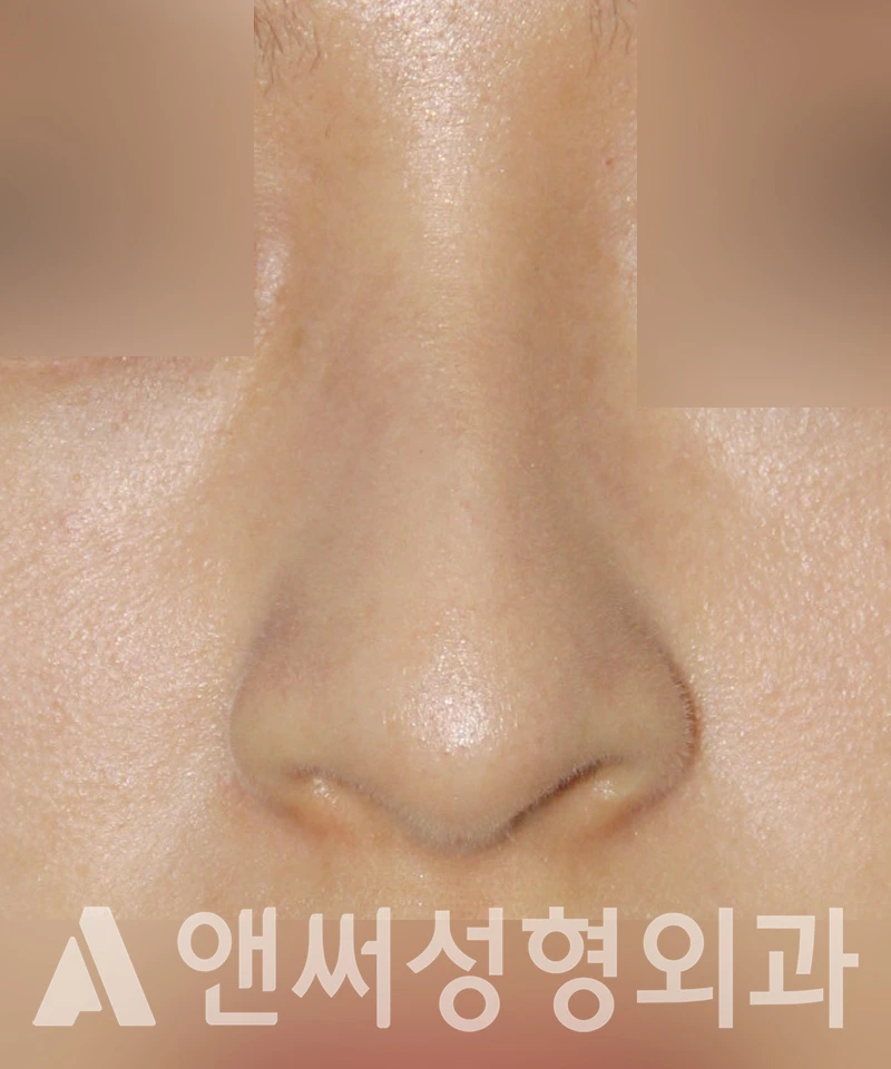 Answer Plastic Surgery case 435: Before