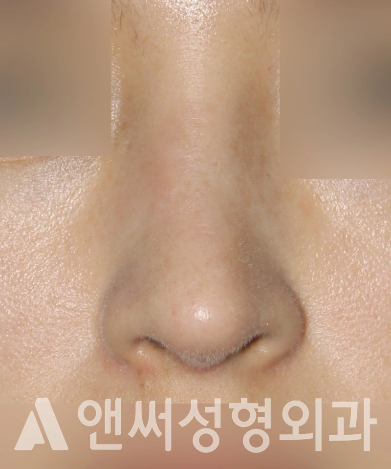 Answer Plastic Surgery case 435: After