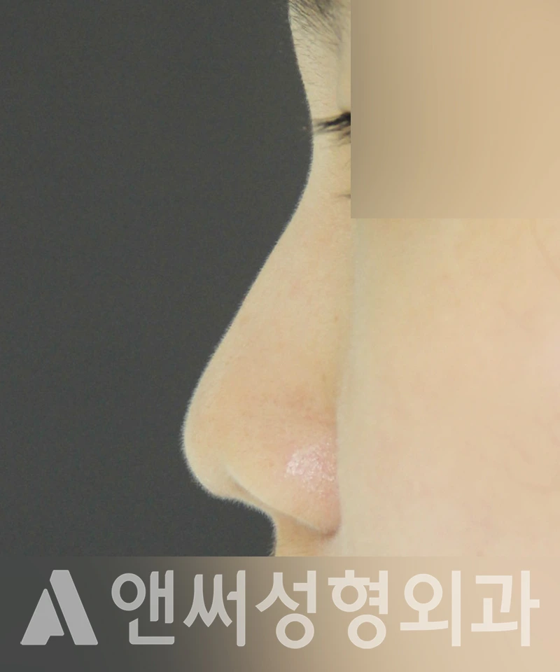 Answer Plastic Surgery case 434: Before