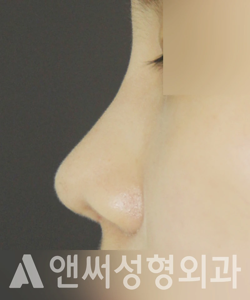 Answer Plastic Surgery case 434: After