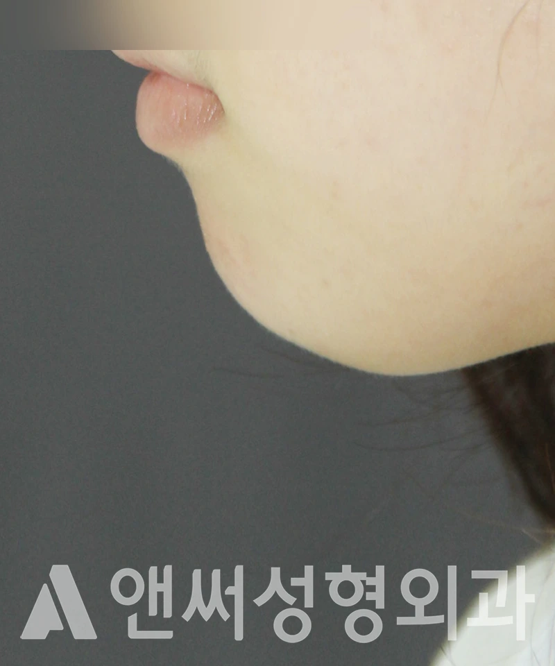 Answer Plastic Surgery case 433: Before