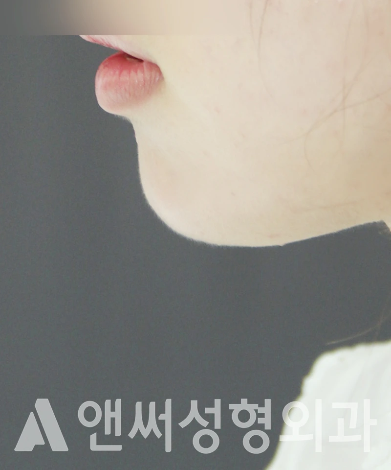 Answer Plastic Surgery case 433: After
