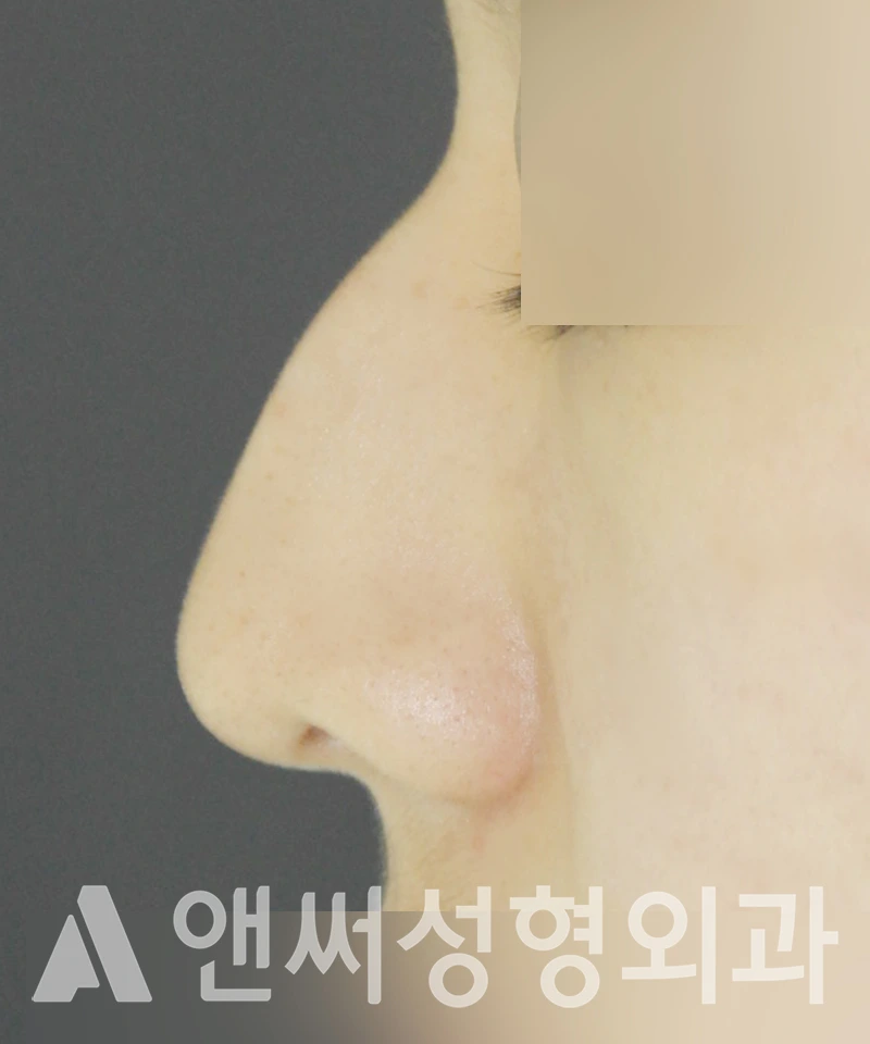 Answer Plastic Surgery case 432: Before