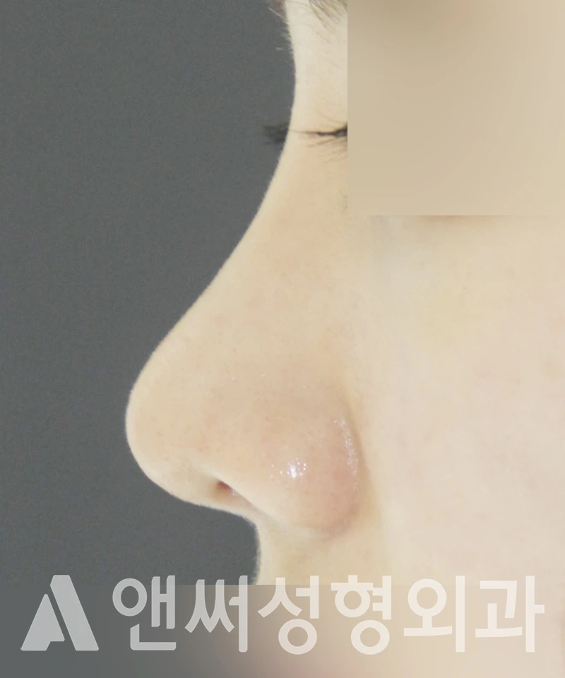 Answer Plastic Surgery case 432: After