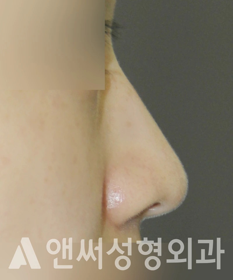 Answer Plastic Surgery case 430: Before