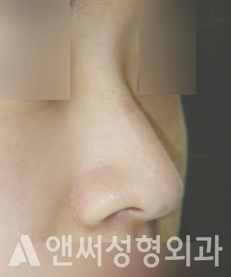 Answer Plastic Surgery case 428: Before