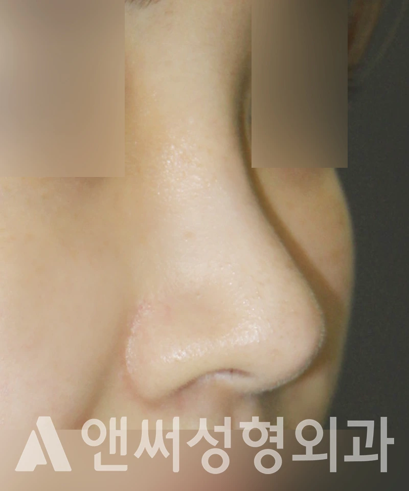 Answer Plastic Surgery case 428: After