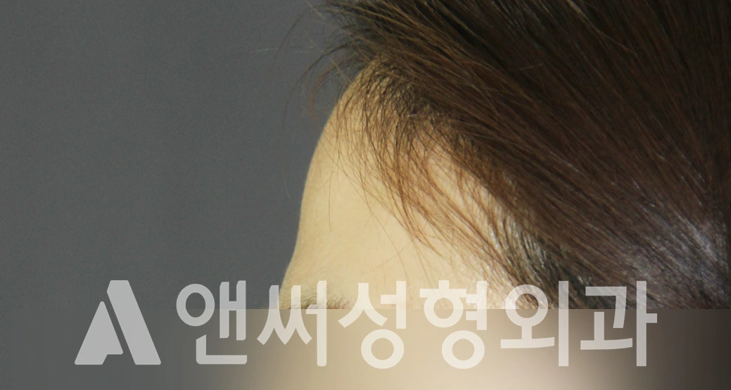 Answer Plastic Surgery case 427: Before