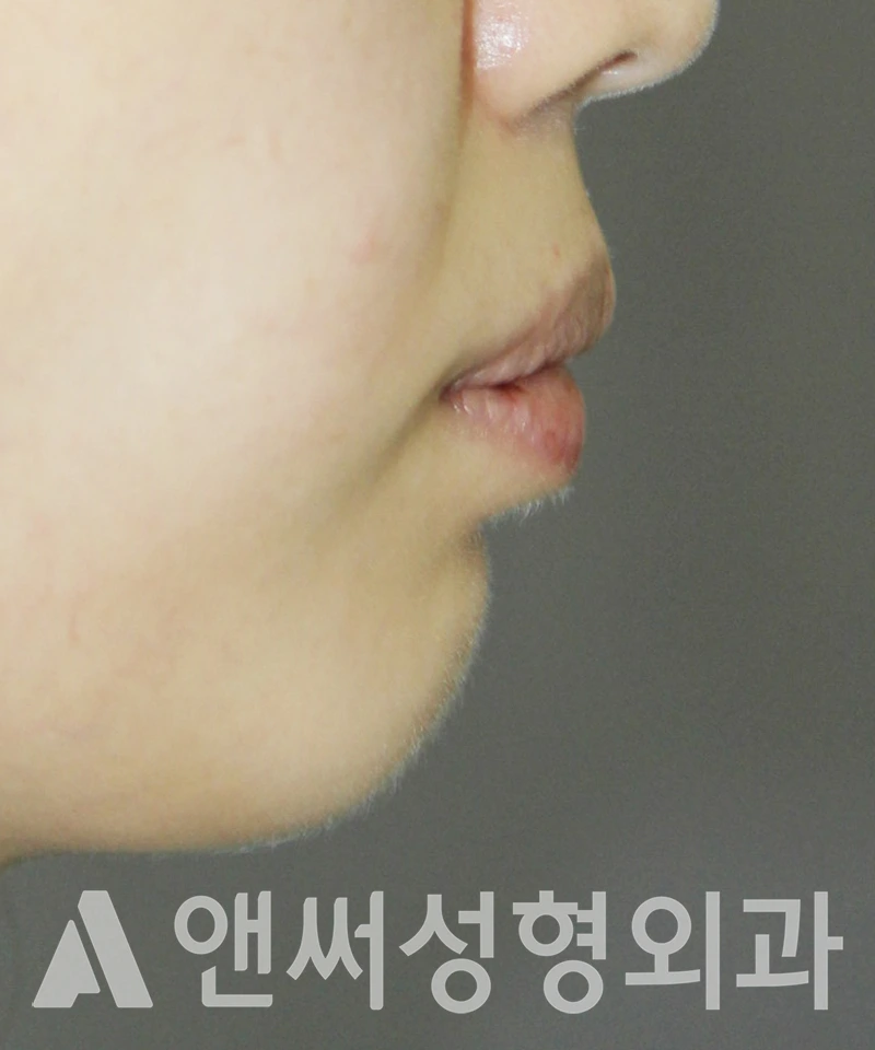 Answer Plastic Surgery case 426: Before