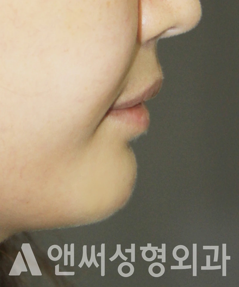 Answer Plastic Surgery case 426: After