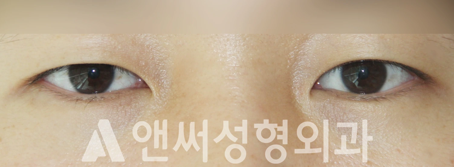 Answer Plastic Surgery case 425: Before