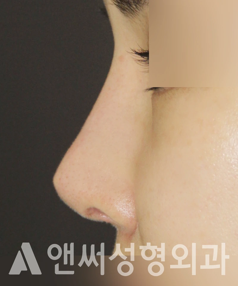 Answer Plastic Surgery case 423: Before