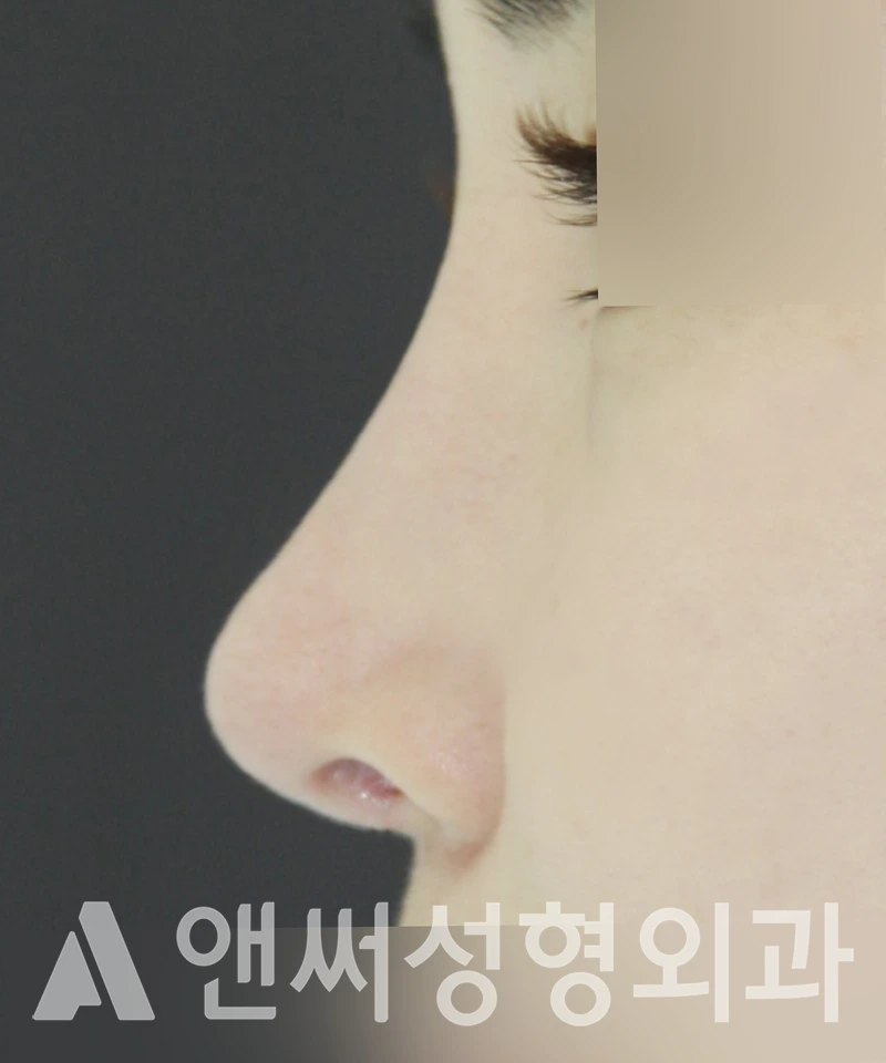 Answer Plastic Surgery case 423: After