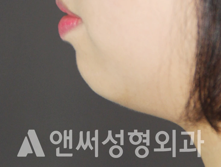Answer Plastic Surgery case 422: Before