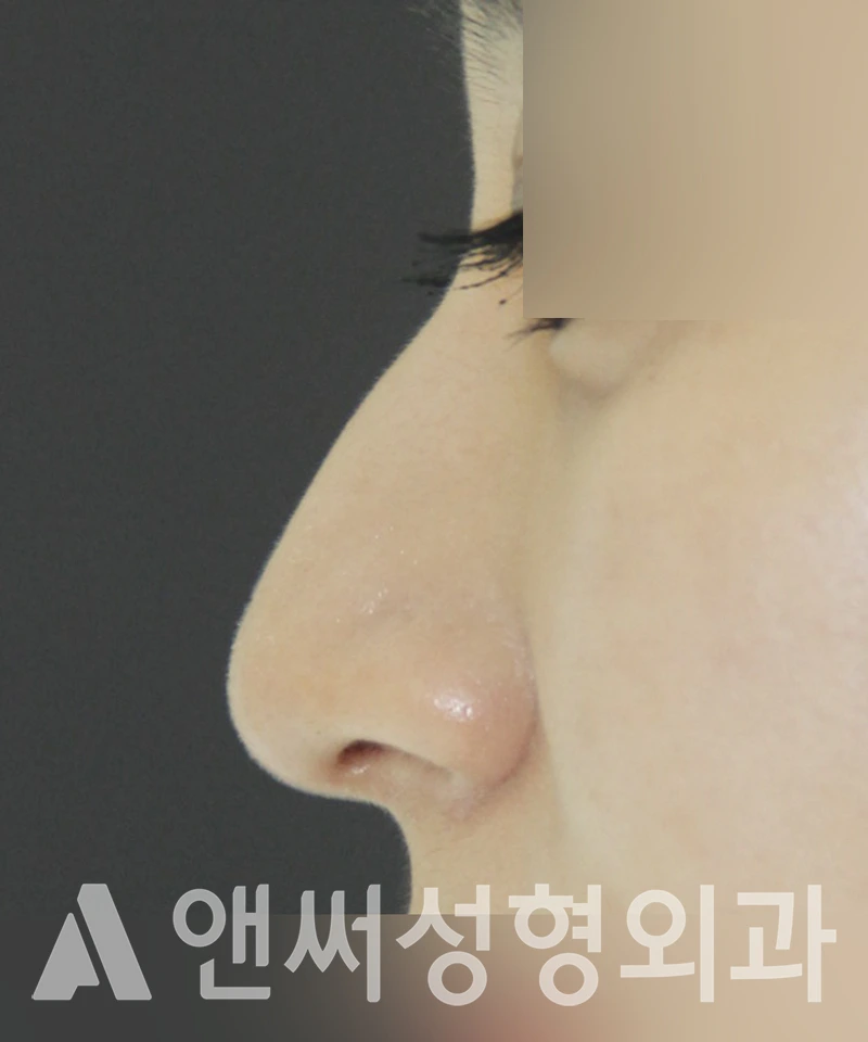 Answer Plastic Surgery case 420: Before