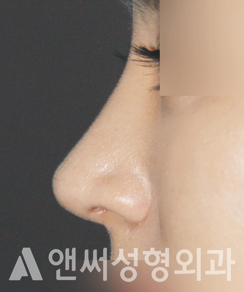 Answer Plastic Surgery case 420: After