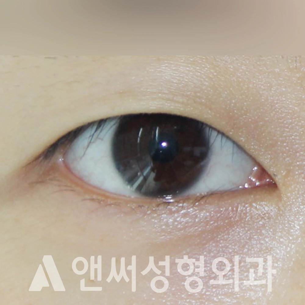 Answer Plastic Surgery case 419: Before