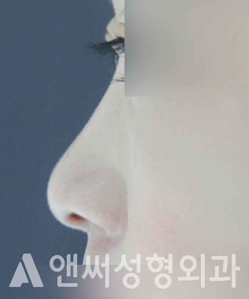 Answer Plastic Surgery case 418: Before