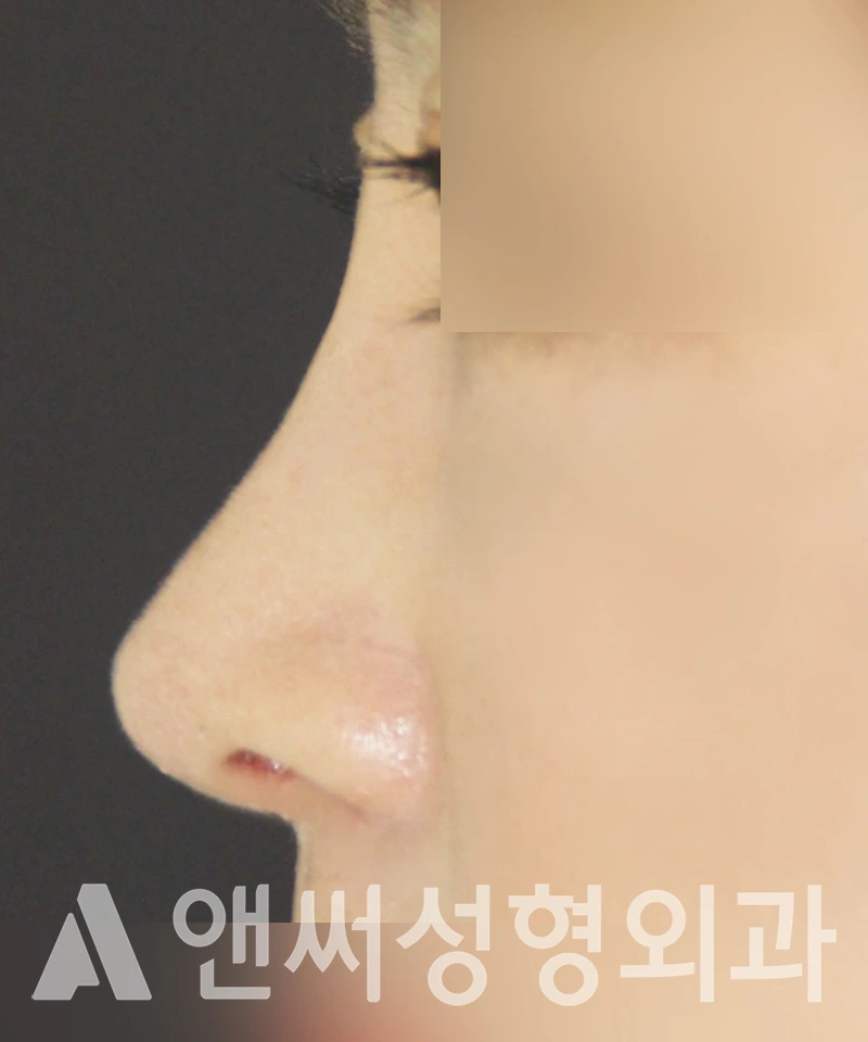 Answer Plastic Surgery case 418: After
