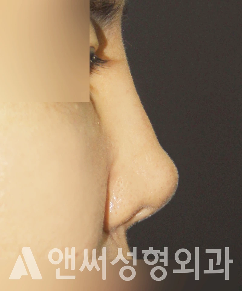 Answer Plastic Surgery case 417: Before