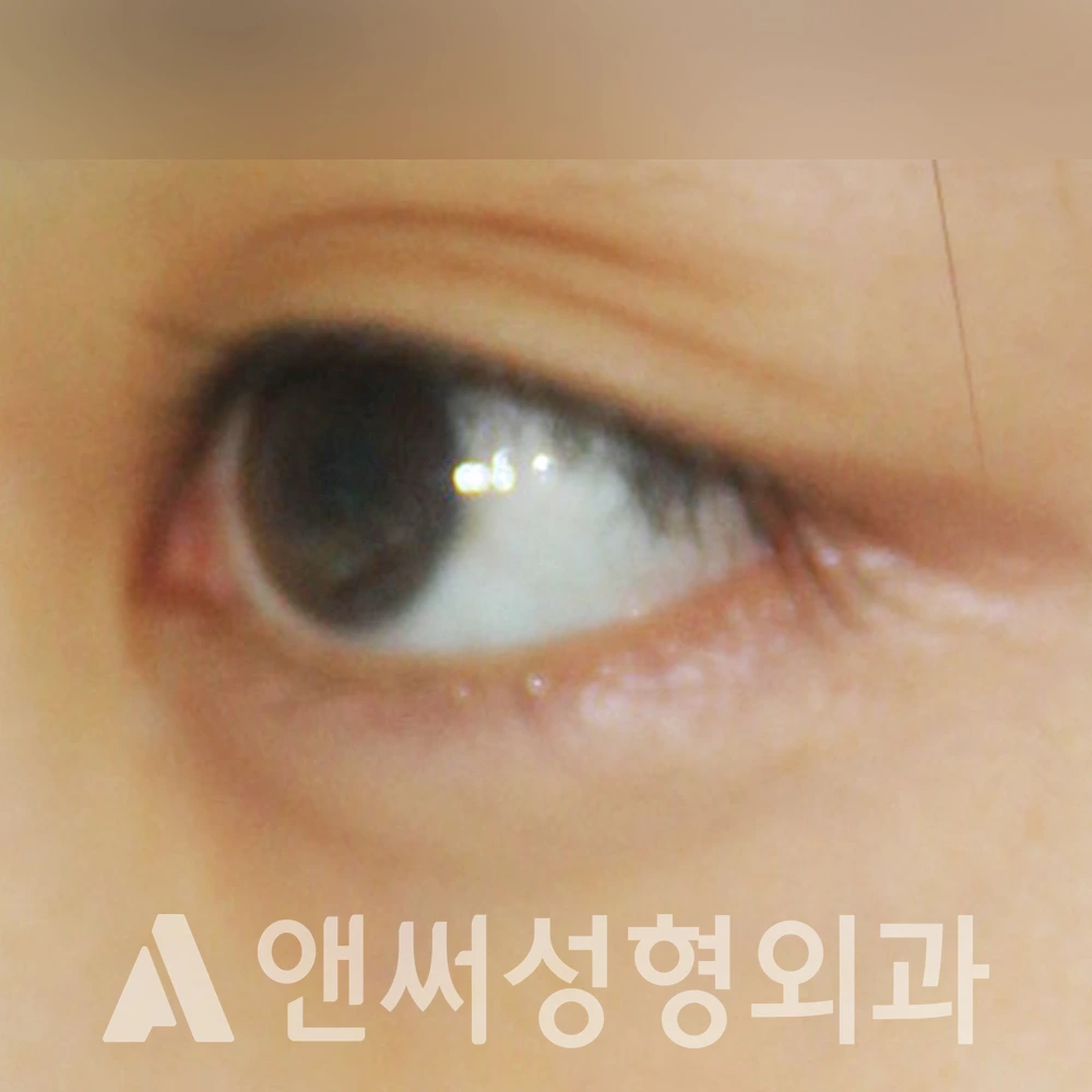 Answer Plastic Surgery case 416: Before