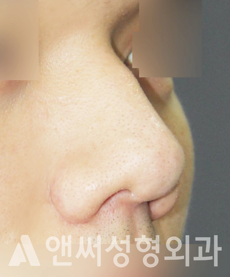 Answer Plastic Surgery case 415: Before