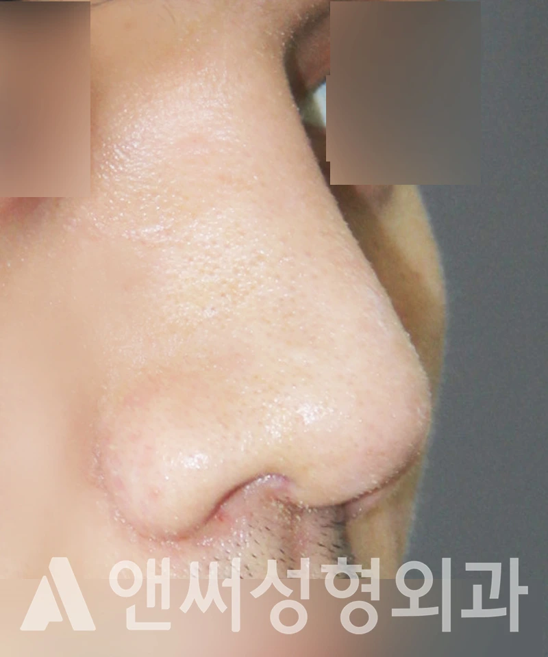 Answer Plastic Surgery case 415: After