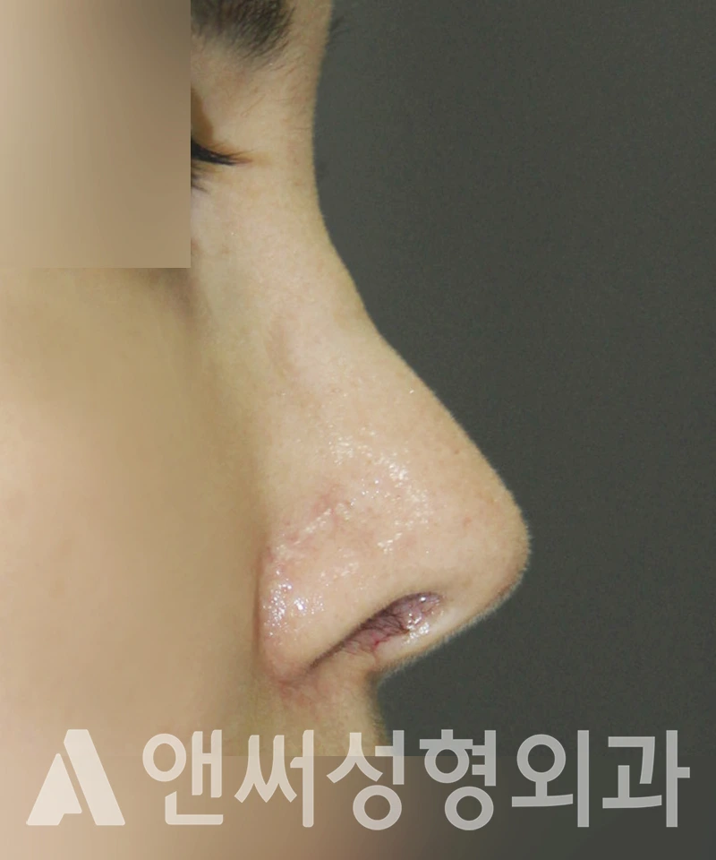 Answer Plastic Surgery case 414: Before