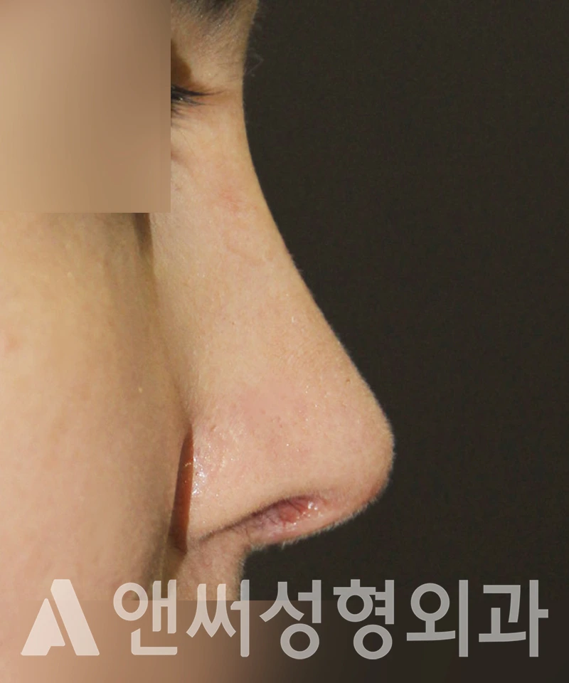 Answer Plastic Surgery case 414: After
