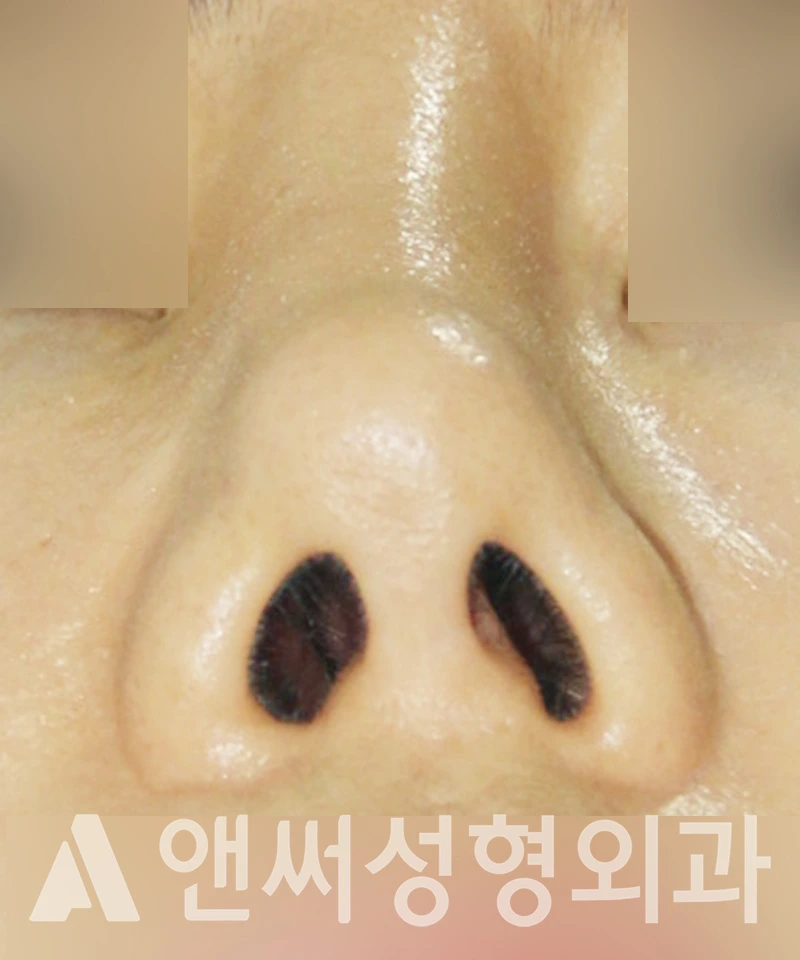 Answer Plastic Surgery case 412: Before