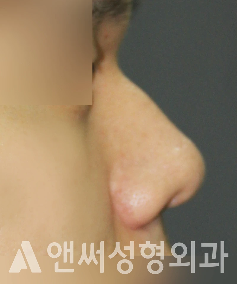 Answer Plastic Surgery case 411: Before