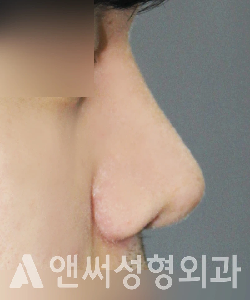 Answer Plastic Surgery case 411: After
