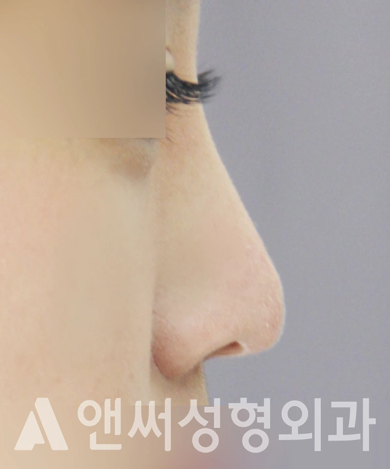 Answer Plastic Surgery case 410: Before