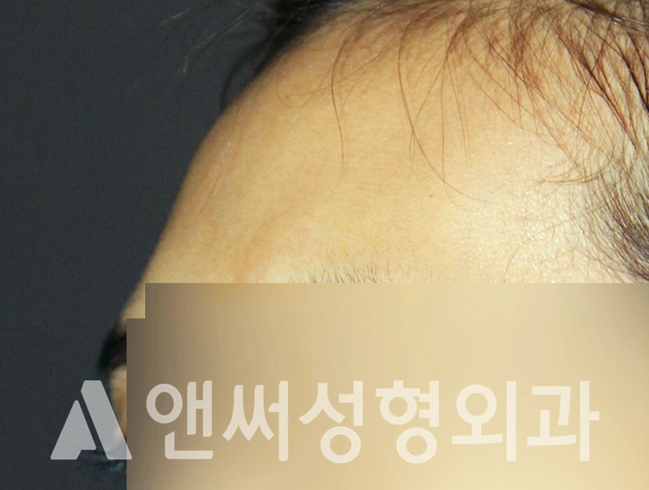 Answer Plastic Surgery case 409: Before