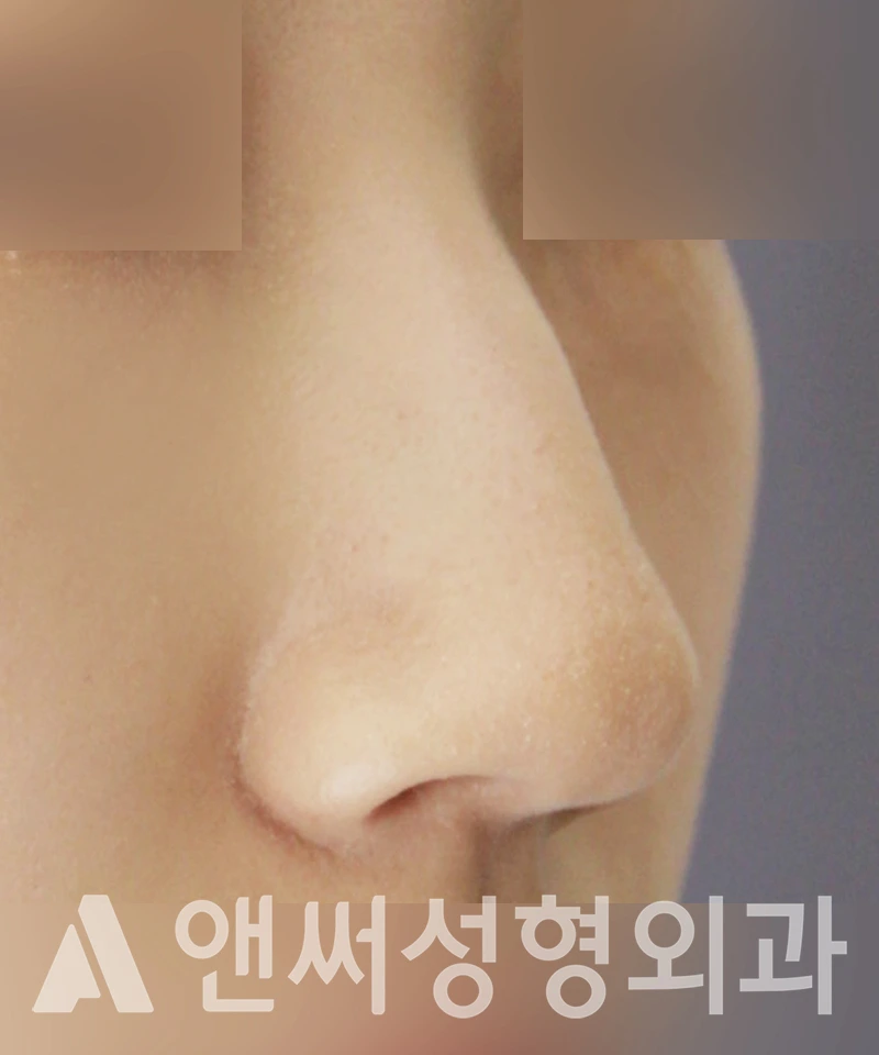 Answer Plastic Surgery case 406: Before