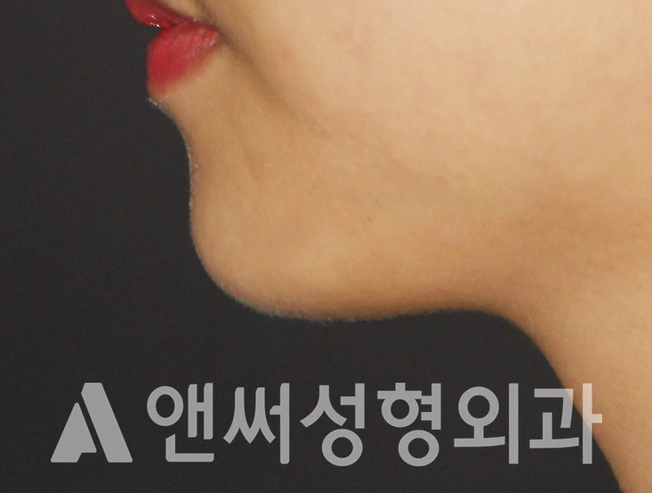 Answer Plastic Surgery case 404: After
